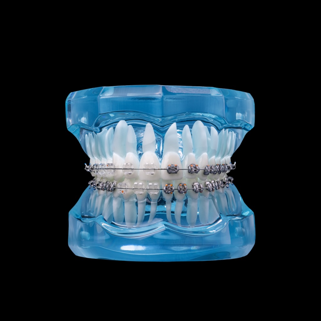 clear braces example